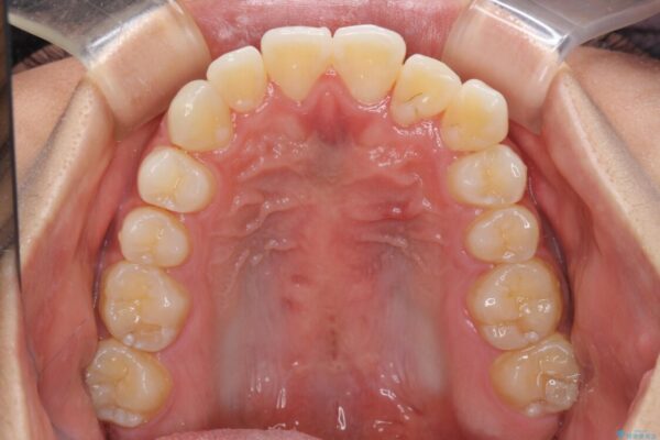 八重歯と奥歯のクロスバイト　上顎骨を拡大してインビザラインで矯正 治療途中画像