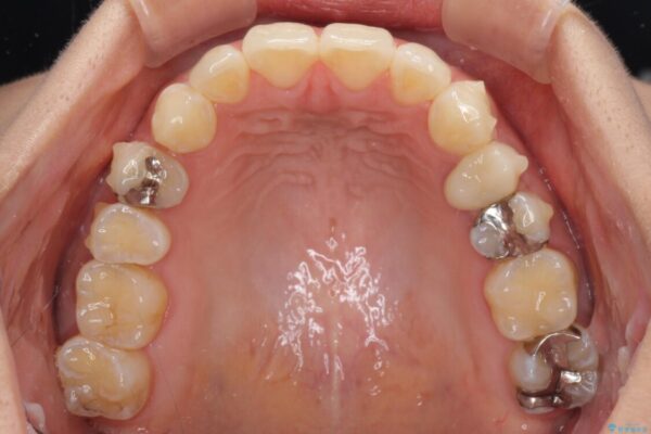 八重歯の再矯正　インビザラインでストレスなく矯正治療 治療途中画像