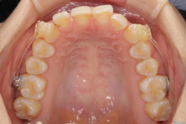 インビザラインによる矯正治療　カリエールディスタライザーを用いた奥歯の咬み合わせ改善 治療途中画像