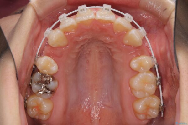 スッキリとした口元へ　出っ歯の抜歯矯正 治療途中画像