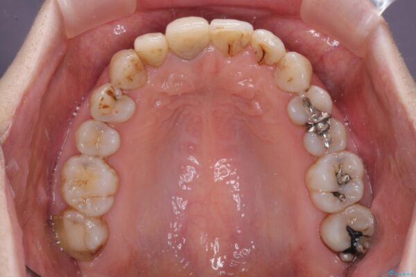 歯並びと目立つ金属を治したい　総合歯科治療 治療途中画像