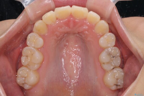 前歯の正中のズレを改善　目立たないワイヤー装置での抜歯矯正 治療後画像