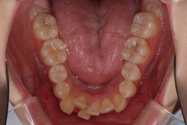 前歯の正中のズレを改善　目立たないワイヤー装置での抜歯矯正 治療前画像