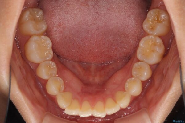 インビザラインによる矯正治療　カリエールディスタライザーを用いた奥歯の咬み合わせ改善 治療前画像