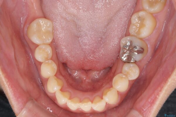 軽度な歯列不正　インビザライン・ライトによる矯正治療 治療前画像