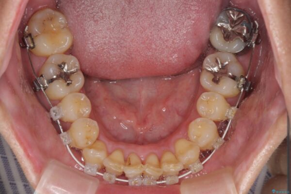 前歯のデコボコ　ワイヤー装置での短期間治療 治療途中画像