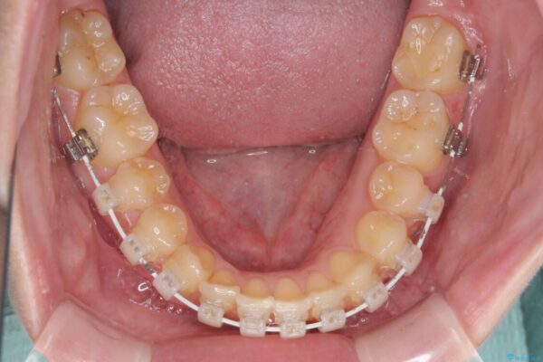 八重歯を短期間で改善　ワイヤー装置による抜歯矯正 治療途中画像