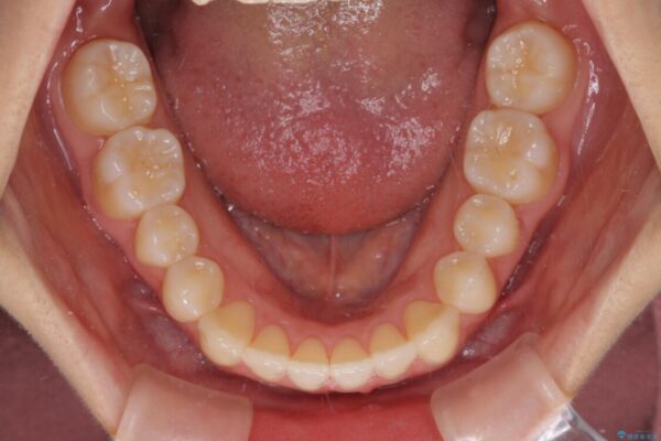 前歯のクロスバイト　インビザラインによる矯正治療 治療途中画像