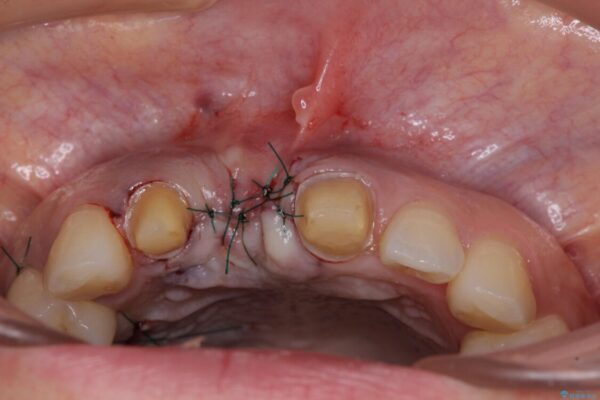 治療途中で放置した前歯　オールセラミックブリッジ 治療途中画像
