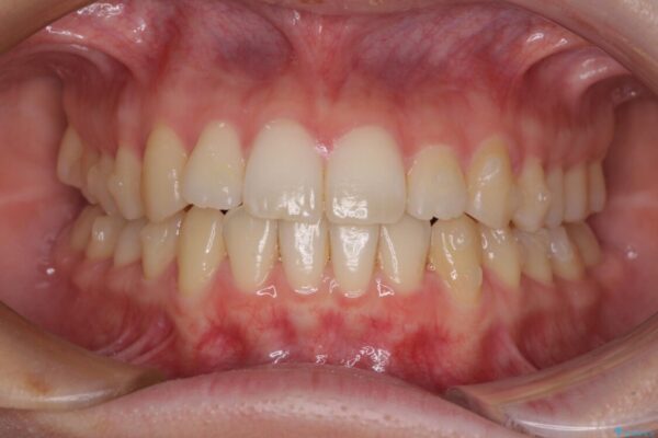 前歯の微妙なガタつきが気になる　インビザライン・ライトでの矯正治療 治療途中画像