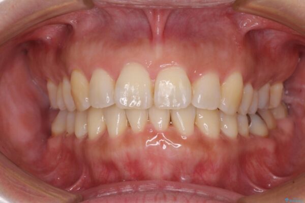 軽度な歯列不正　インビザライン・ライトによる矯正治療 治療途中画像