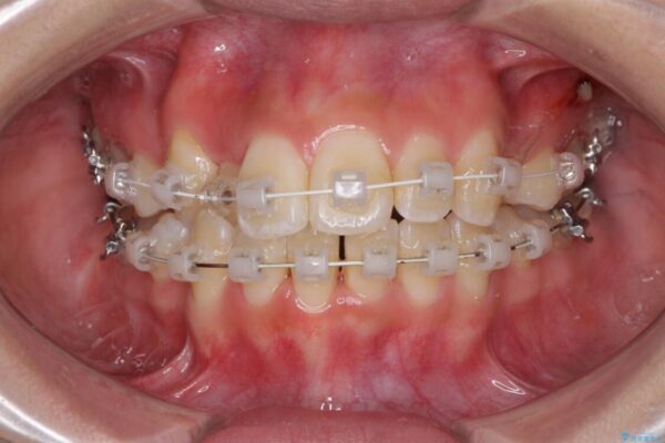 前歯の正中のズレを改善　目立たないワイヤー装置での抜歯矯正 治療途中画像