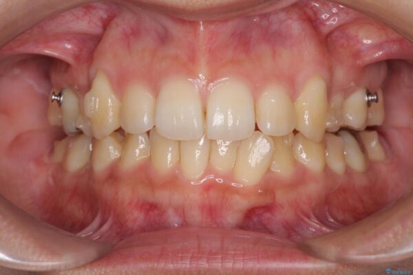 八重歯の抜歯矯正　補助装置を用いたインビザライン矯正 治療途中画像