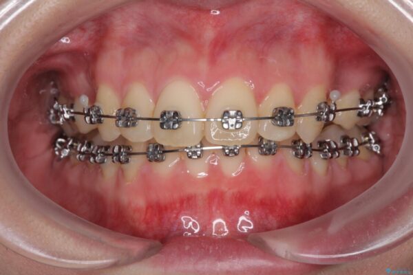 費用を抑えた抜歯矯正　口元の突出感の改善 治療途中画像
