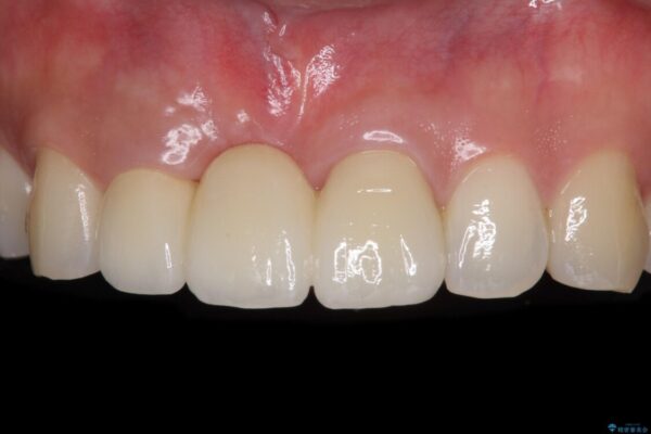 治療途中で放置した前歯　オールセラミックブリッジ 治療後画像