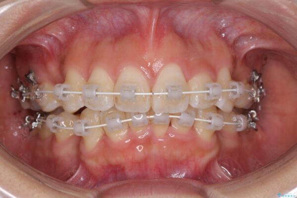 スッキリとした口元へ　出っ歯の抜歯矯正 治療途中画像