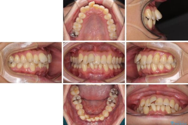 前歯のデコボコ　ワイヤー装置での短期間治療 治療前画像