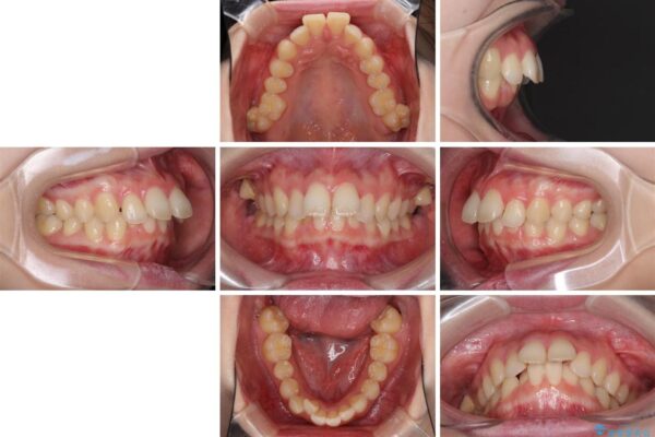 費用を抑えた抜歯矯正　口元の突出感の改善 治療前画像