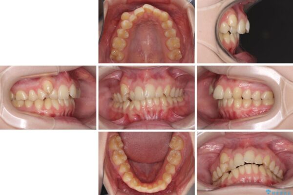 八重歯を短期間で改善　ワイヤー装置による抜歯矯正 治療前画像