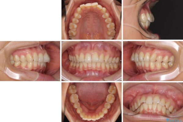 インビザラインによる矯正治療　カリエールディスタライザーを用いた奥歯の咬み合わせ改善 治療前画像