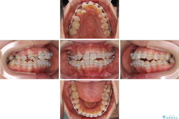 狭い上顎骨を拡大　著しい叢生を抜歯矯正で改善 治療途中画像
