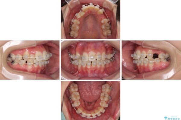前歯の正中のズレを改善　目立たないワイヤー装置での抜歯矯正 治療途中画像