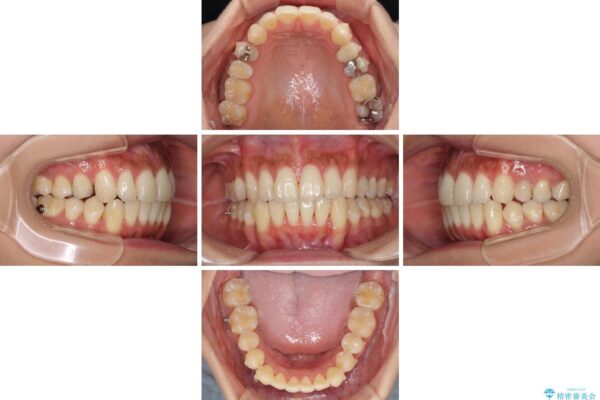 八重歯の再矯正　インビザラインでストレスなく矯正治療 治療途中画像