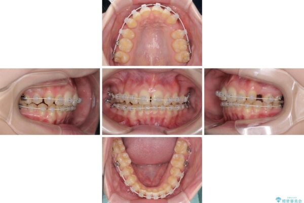 八重歯を短期間で改善　ワイヤー装置による抜歯矯正 治療途中画像
