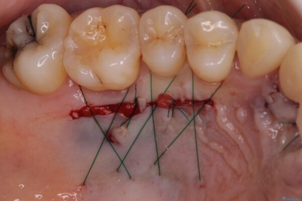 治療途中で放置した前歯　オールセラミックブリッジ 治療途中画像