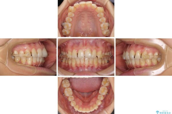 インビザラインによる矯正治療　カリエールディスタライザーを用いた奥歯の咬み合わせ改善 治療途中画像