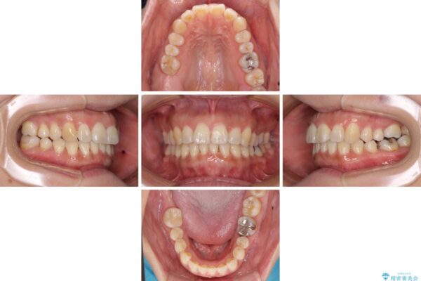 軽度な歯列不正　インビザライン・ライトによる矯正治療 治療途中画像