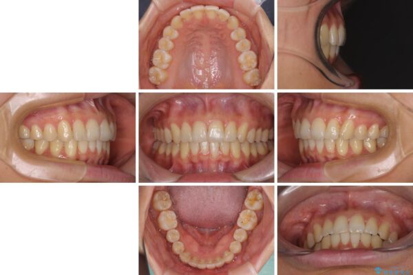 インビザラインによる矯正治療　カリエールディスタライザーを用いた奥歯の咬み合わせ改善 治療後画像