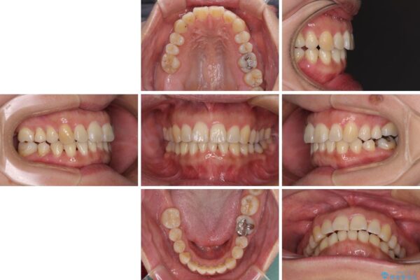 軽度な歯列不正　インビザライン・ライトによる矯正治療 治療後画像