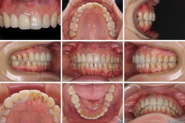 歯並びと目立つ金属を治したい　総合歯科治療 治療後画像
