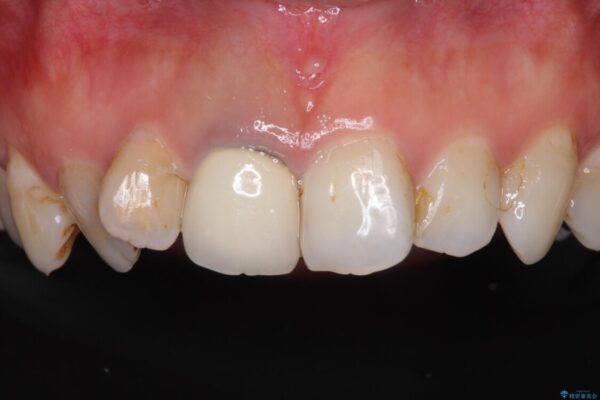 歯並びと目立つ金属を治したい　総合歯科治療 治療前画像