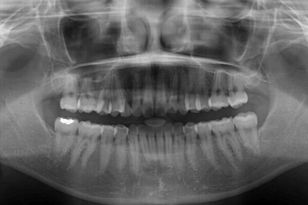 狭い上顎骨を拡大　急速拡大装置を併用したインビザライン矯正 治療後画像