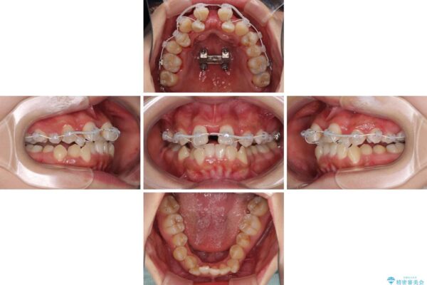 前後に重なった前歯　ワイヤー装置と急速拡大装置を併用したインビザライン矯正 治療途中画像