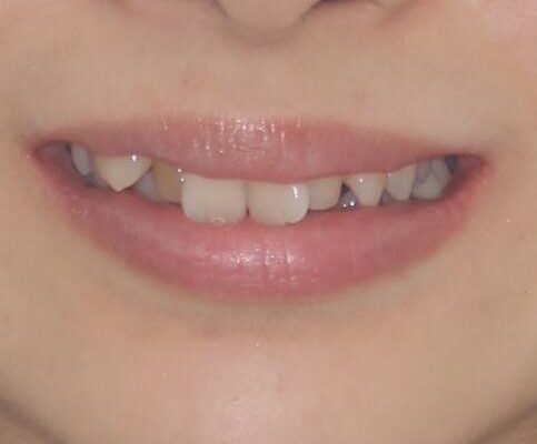 前歯2本が欠損　抜歯矯正でデコボコを治す 治療前画像
