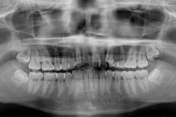 八重歯と奥歯のクロスバイト　上顎骨を拡大してインビザラインで矯正 治療前画像