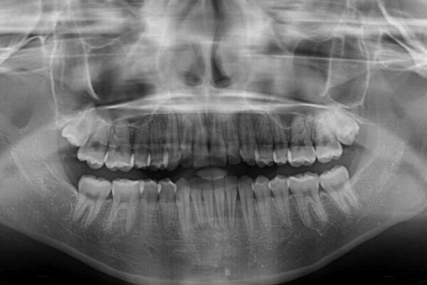 前歯のクロスバイト　インビザラインによる矯正治療 治療後画像
