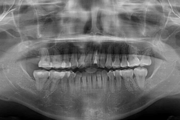 狭い上顎骨を拡大　著しい叢生を抜歯矯正で改善 治療後画像
