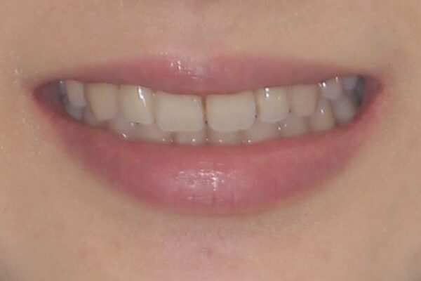 前歯2本が欠損　抜歯矯正でデコボコを治す 治療後画像