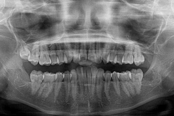 費用を抑えた抜歯矯正　口元の突出感の改善 治療前画像