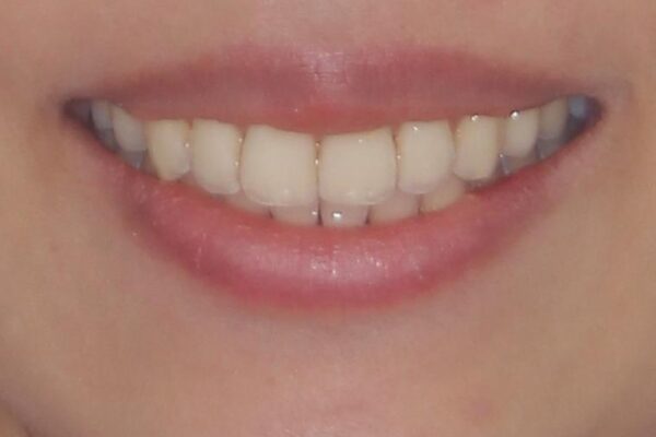 八重歯の再矯正　インビザラインでストレスなく矯正治療 治療後画像