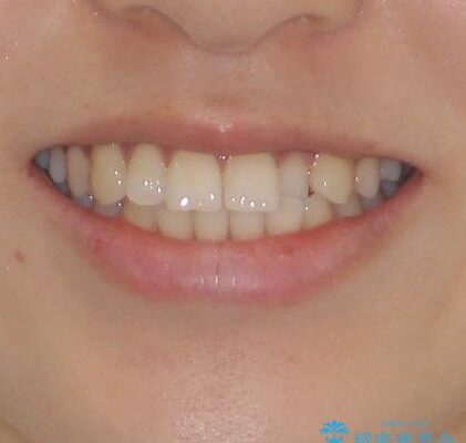 前歯のクロスバイト　インビザラインによる矯正治療 治療前画像
