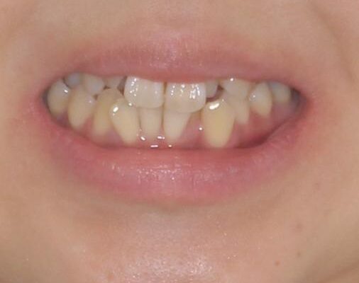 狭い上顎骨を拡大　著しい叢生を抜歯矯正で改善 治療前画像