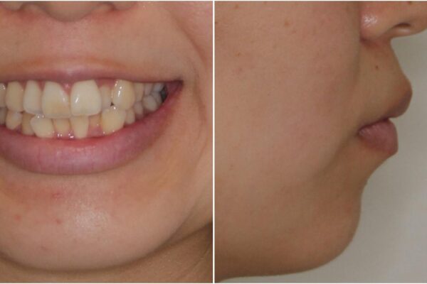スッキリとした口元へ　出っ歯の抜歯矯正 治療前画像