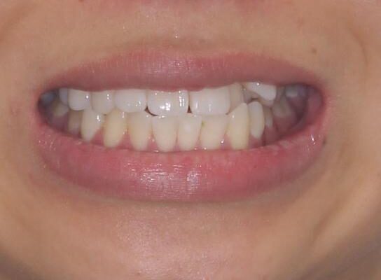 八重歯と奥歯のクロスバイト　上顎骨を拡大してインビザラインで矯正 治療前画像
