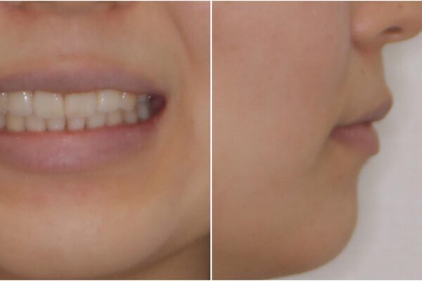スッキリとした口元へ　出っ歯の抜歯矯正 治療後画像