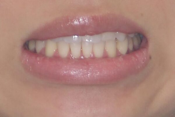八重歯と奥歯のクロスバイト　上顎骨を拡大してインビザラインで矯正 治療後画像